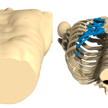 Pectus Excavatum case of the month