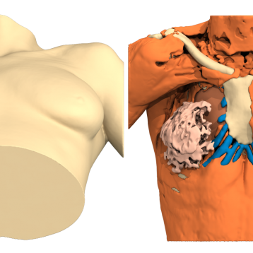 Poland Syndrome case of the month